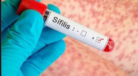 sifilis